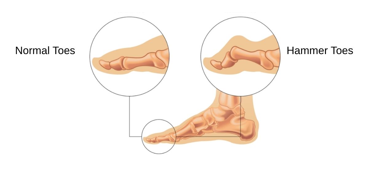Hammer Toes